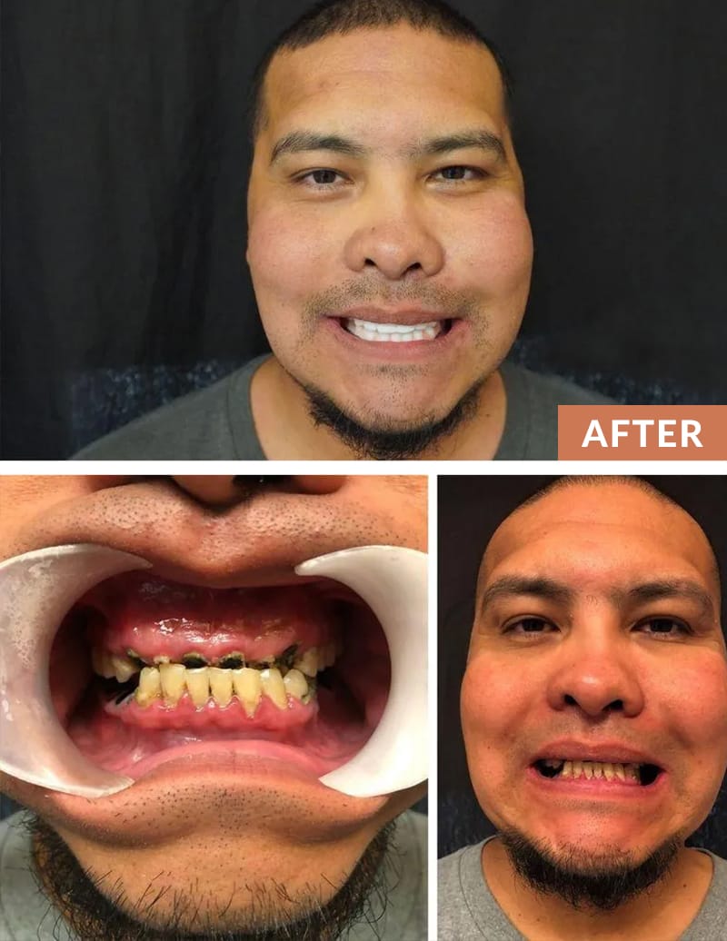 Before and After Patient Teeth Images