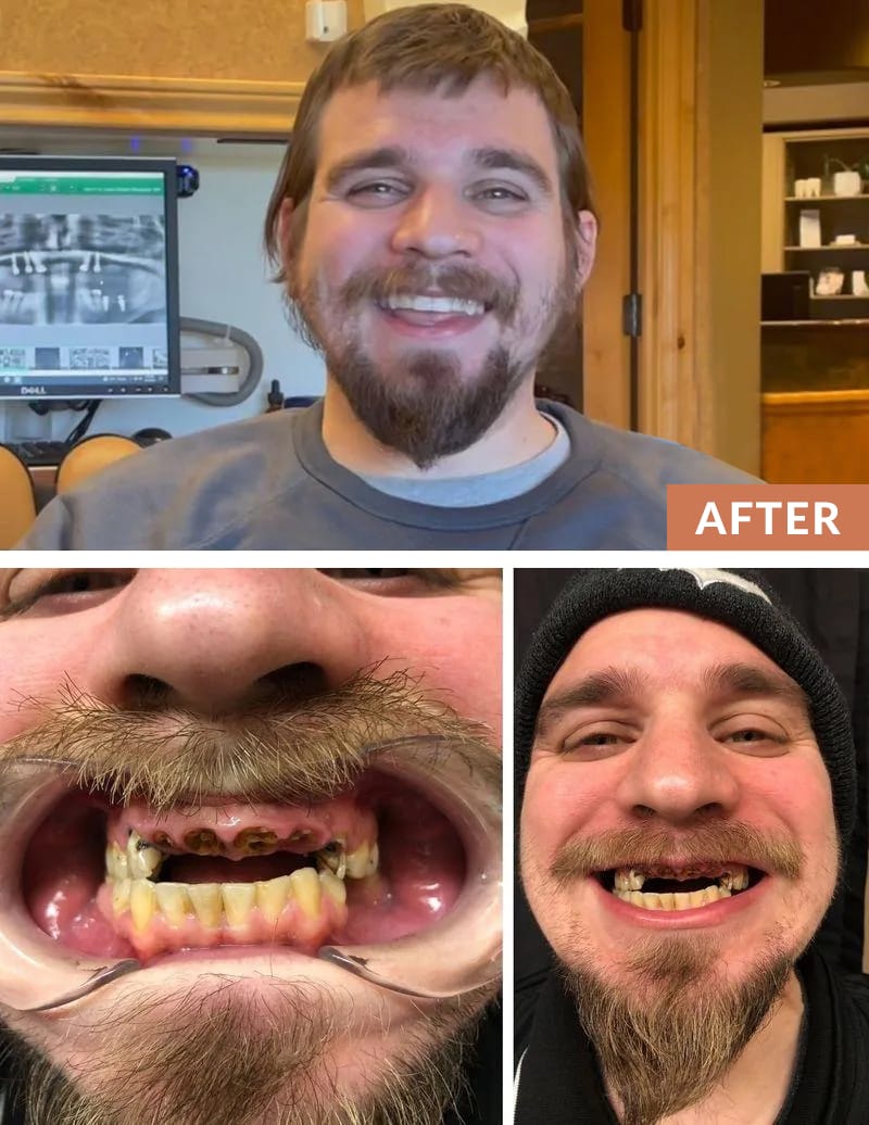 Before and After Dental Implants