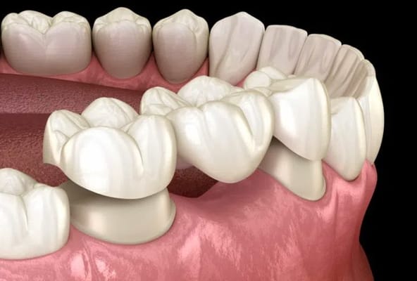 Dental Bridge