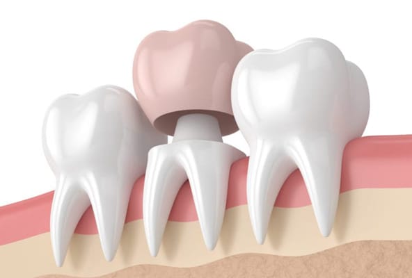 Dental Crowns