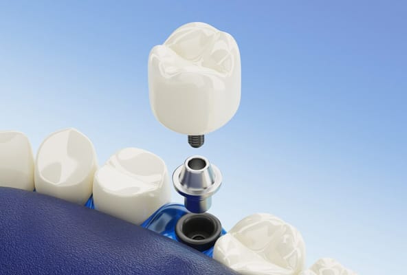 Dental Implants