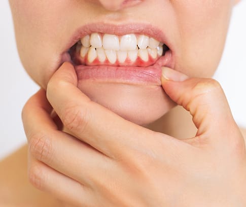 Gum Disease Treatment