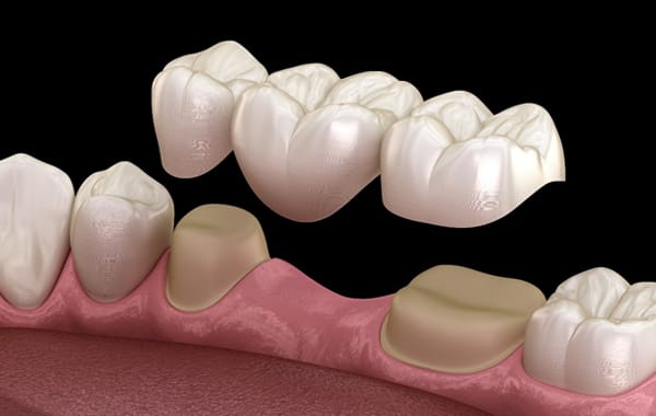 Building a Dental Bridge