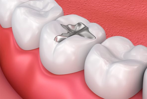 Dental Fillings
