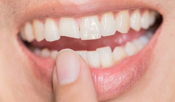 Dental Trauma