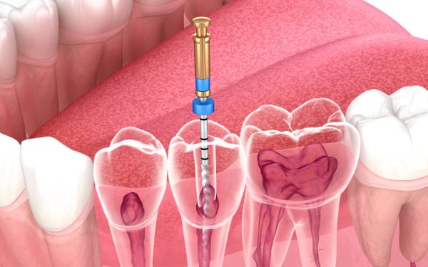 Endodontics