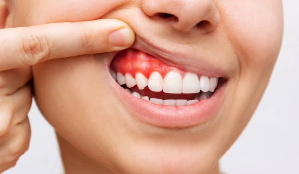 Gum Injury