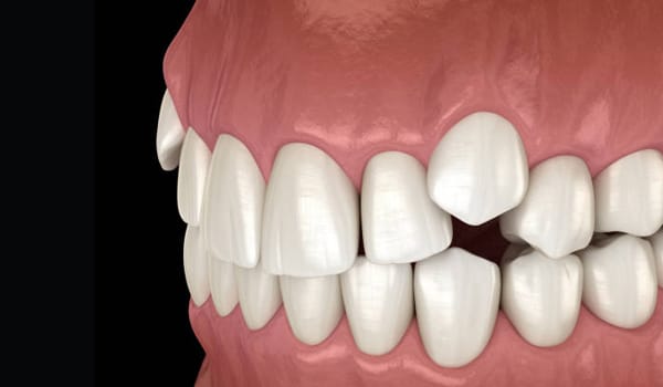 Treatment of Impacted Canines