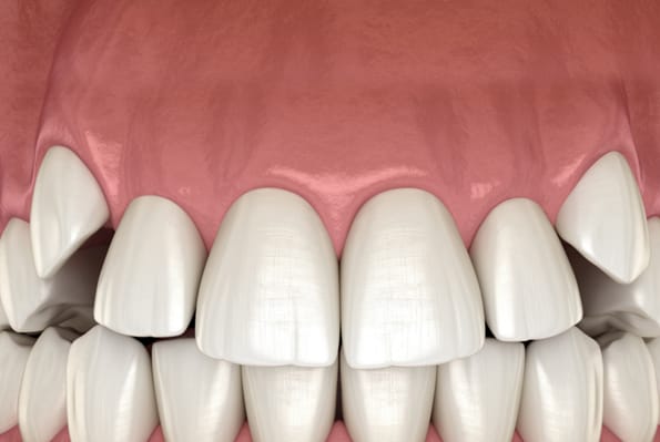 Impacted Canines
