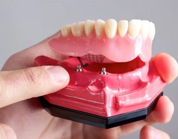 Implant Supported Dentures
