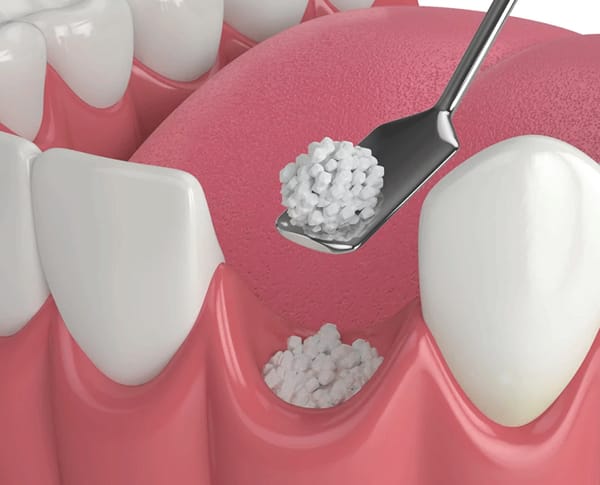 Grafting Maintains Oral Health