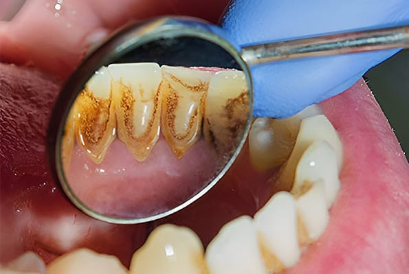 Oral Disease