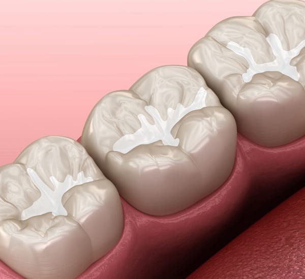 Dental Sealants