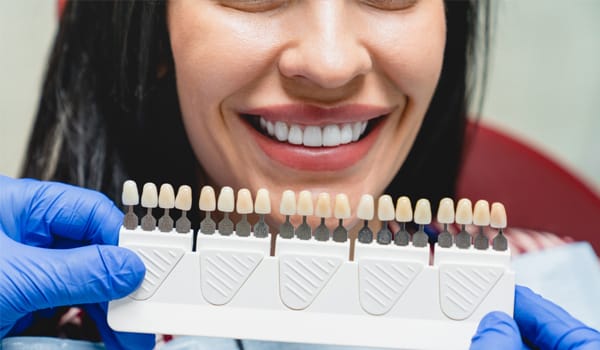 Standard Dental Veneers
