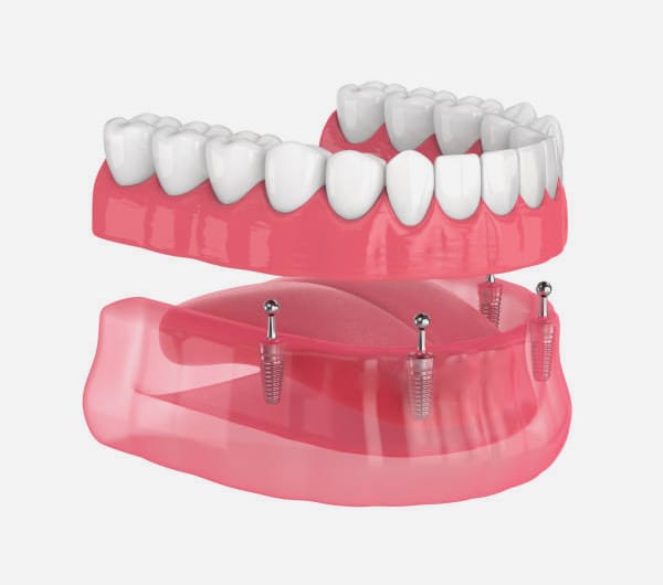 All-on-4 Implant Dentures Process