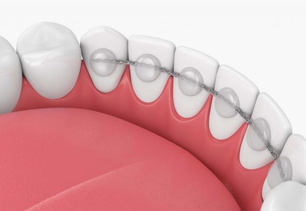 Dental Bonding Procedure