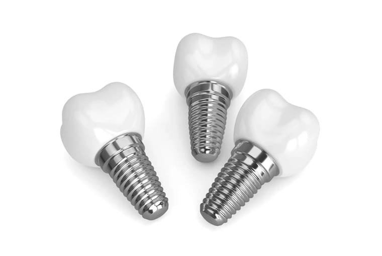 Why Dental Implants?