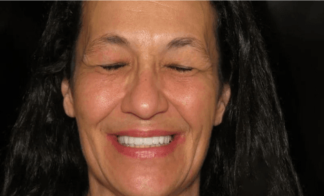 After Teeth Implants
