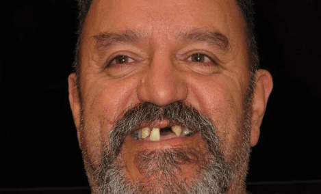 Before Restore Your Smile