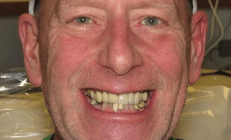 Before Teeth Cleaning