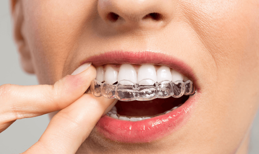 How Invisalign Can Straighten Your Smile Without Braces