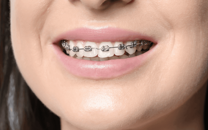 Orthodontic Emergencies