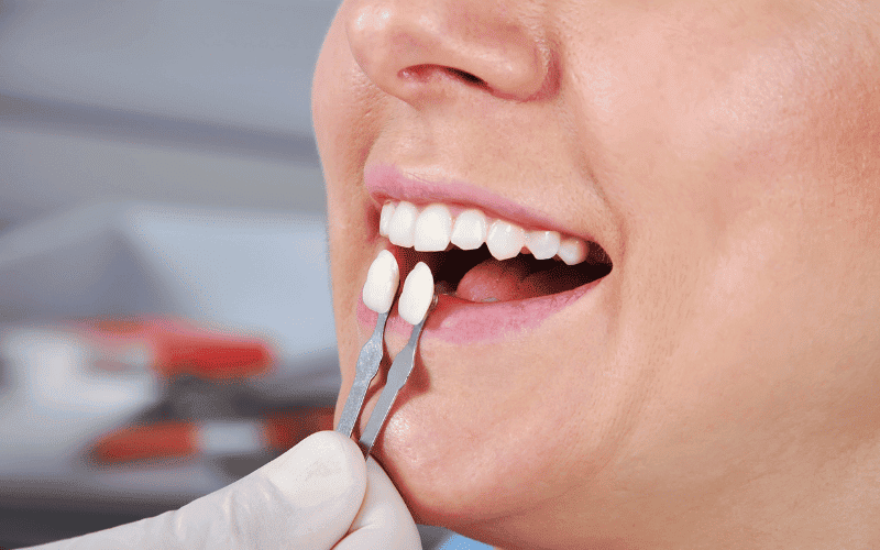 Dental Veneers