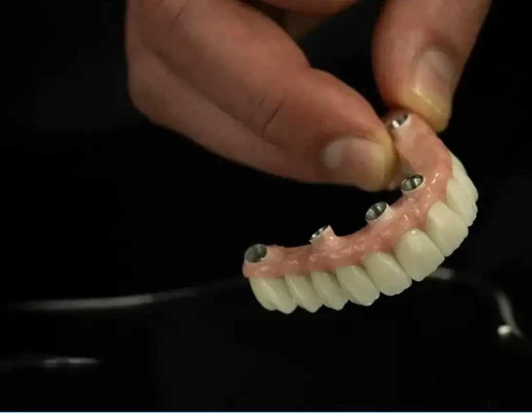 All-on-4 Dental Implants